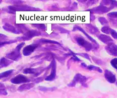 Small cell carcinoma is a cancer where the presence of smudging is a clue to the diagnosis.