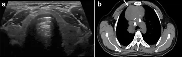 Fig. 4. A 45-year-old male patient presented with anterior mediastinal metastatic PTC lesions and occult primary on imaging. Histopathology examination of the resected thyroid gland revealed micro-foci of PTC; the largest, in the isthmus, measured 4 mm. a transverse greyscale ultrasound of the thyroid demonstrates homogeneous gland with normal echogenicity and size. No focal lesion or micro-calcifications. b Non-enhanced CT scan obtained as part of PET/CT examination shows a heterogeneous, large, relatively dense anterior mediastinal mass (white arrow) with peripheral calcification (arrowheads). Thyroid gland has normal CT appearance with no abnormal FDG uptake (not shown).